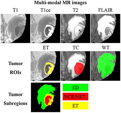 Brain Tumor Segmentation From Multi-Modal MR Images via Ensembling UNets